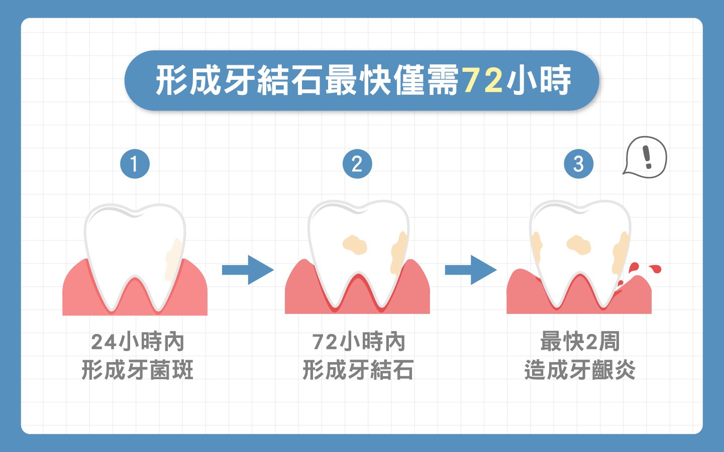 形成牙結石最快僅需72小時